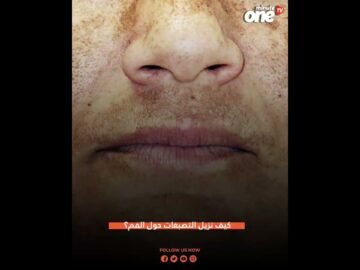 كيف نزيل التصبغات حول الفم