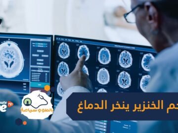 دود ينخر الدماغ بسبب تناول لحم الخنزير.. اكتشاف يرقات دودة شريطية في مخ امرأة أسترالية