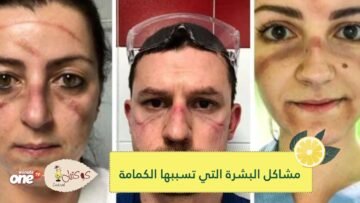 حلول عملية لمشاكل البشرة التي يسبّبها ارتداء الكمامة