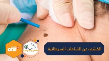 نوتا ابتكار مذهل للكشف عن الشامات السرطانية