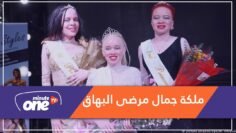 شاهد.. مسابقة ملكة جمال مرضى البهاق