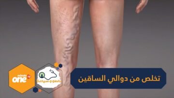 إذا كنت تعاني من دوالي الساقين.. إليك 9 خطوات لمعالجتها