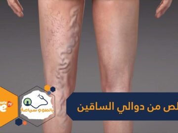 إذا كنت تعاني من دوالي الساقين.. إليك 9 خطوات لمعالجتها