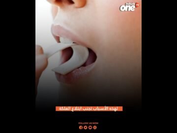 أضرار تسببها العلكة انتبه إليها!