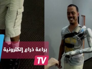 ذراع إلكترونية تحاكي وظيفة الذراع المفقودة