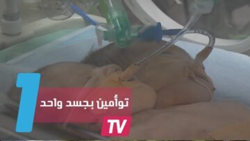 ولادة توأمين برأسين وجسد واحد في غزة