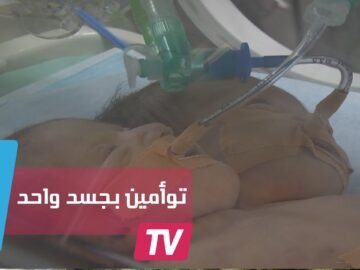 ولادة توأمين برأسين وجسد واحد في غزة