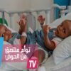 توأم ملتصق من الحوض يخضع لعملية فصل استغرقت 18 ساعة