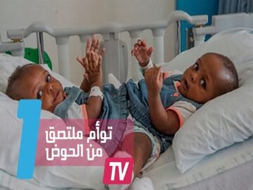 توأم ملتصق من الحوض يخضع لعملية فصل استغرقت 18 ساعة