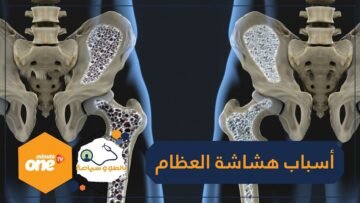 تعرف على أسباب إصابة الجسم بـهشاشة العظام
