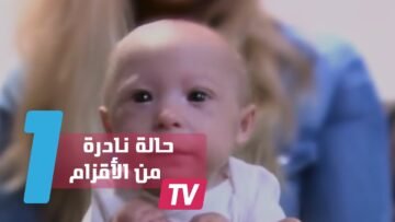 شكل نادر من الأقزام لطفل لا يتجاوز 7 أشهر