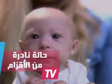 شكل نادر من الأقزام لطفل لا يتجاوز 7 أشهر