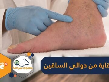 8 نصائح للوقاية من ظهور دوالي الساقين