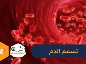 الإسهال والدوخة أبرز علامات تسمم الدم.. فما هي أعراضه الأخرى؟