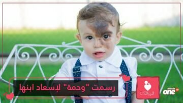 أم ترسم وحمة على وجهها لعلاج ابنها نفسيا