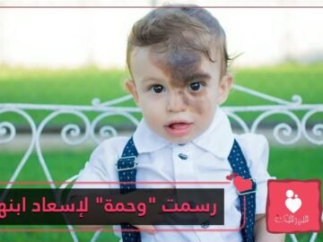 أم ترسم وحمة على وجهها لعلاج ابنها نفسيا